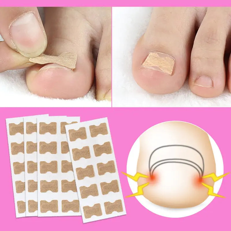 50 PCS Fertoe™ Toenail Corrector Patch