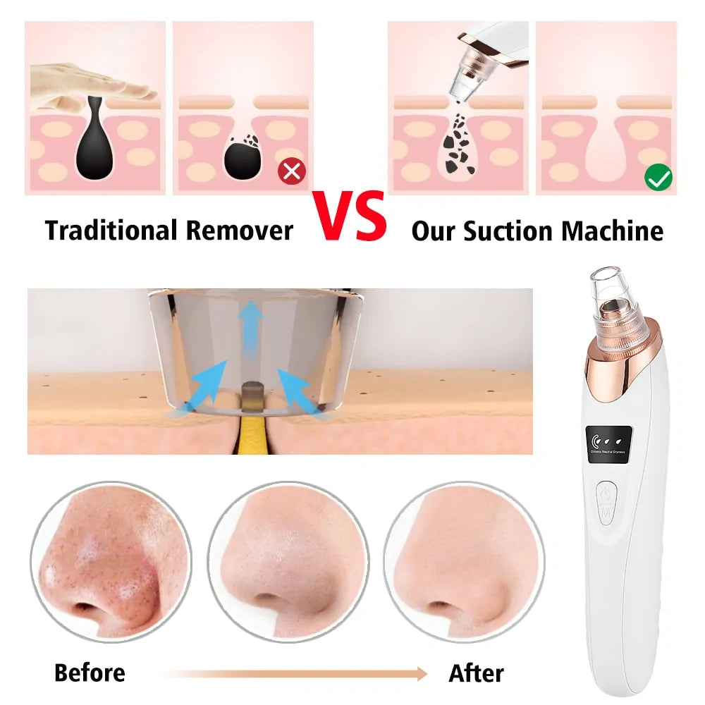 ACNE REMOVER