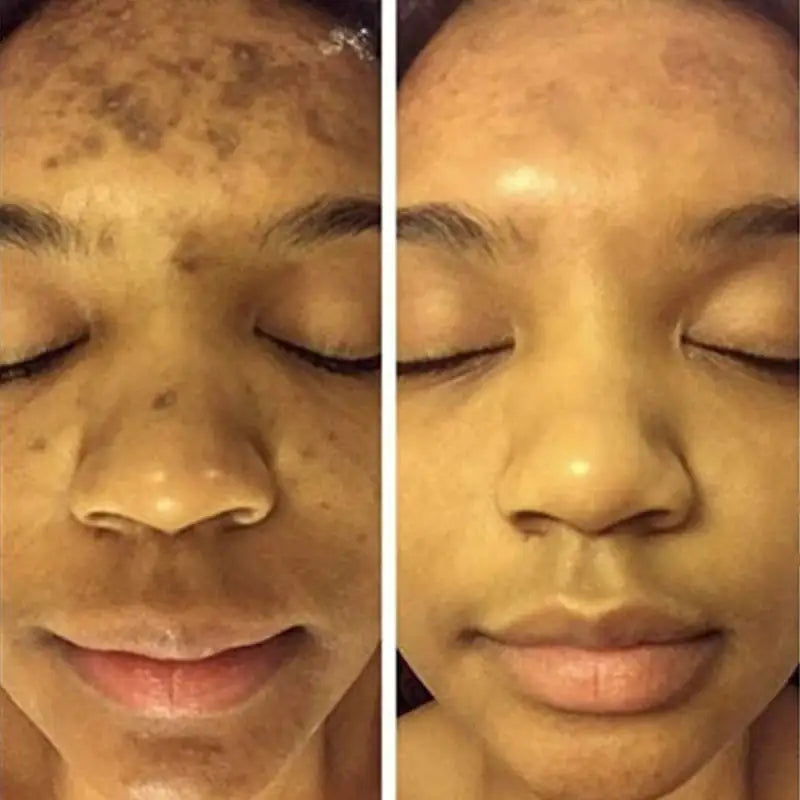 NATURAL SPOTS FREE SERUM